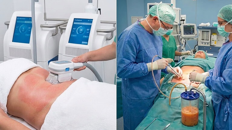 Kryolipolyse vs. Fettabsaugung
